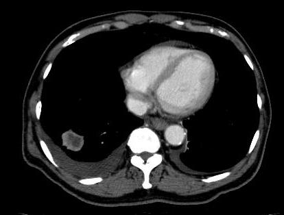 CT Chest Lung Cancer